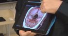 Doctors diagnose stroke with iPhone app