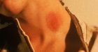 Teen dies 'after girlfriend's hickey formed blood clot that travelled to brain causing stroke'